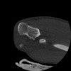 SPORK, NICO - 22.03.1976 - 02.08.2022 - CT obere Extremität - 17:51:17